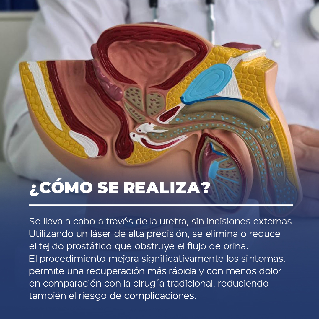 Pastilla-Engrosamiento_02 Cómo se realiza la vasectomía